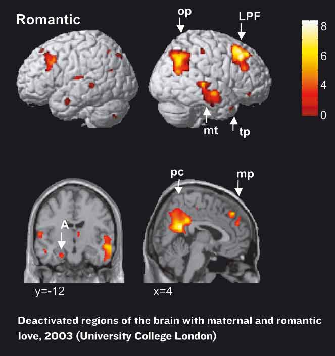 Love Pheromones: 6 Scientific Stages Of Falling In Love Explained (Romantically) brain scan showing deactivated parts of the brain when people are in love